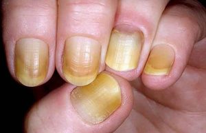 Yellow-Nail-Syndrome