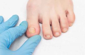 Doctor examines ingrown nail on female leg, onychocryptosis, close-up, white background, medical, inspection