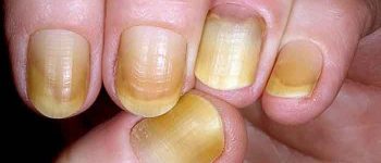 Yellow-Nail-Syndrome