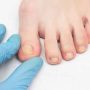 Doctor examines ingrown nail on female leg, onychocryptosis, close-up, white background, medical, inspection